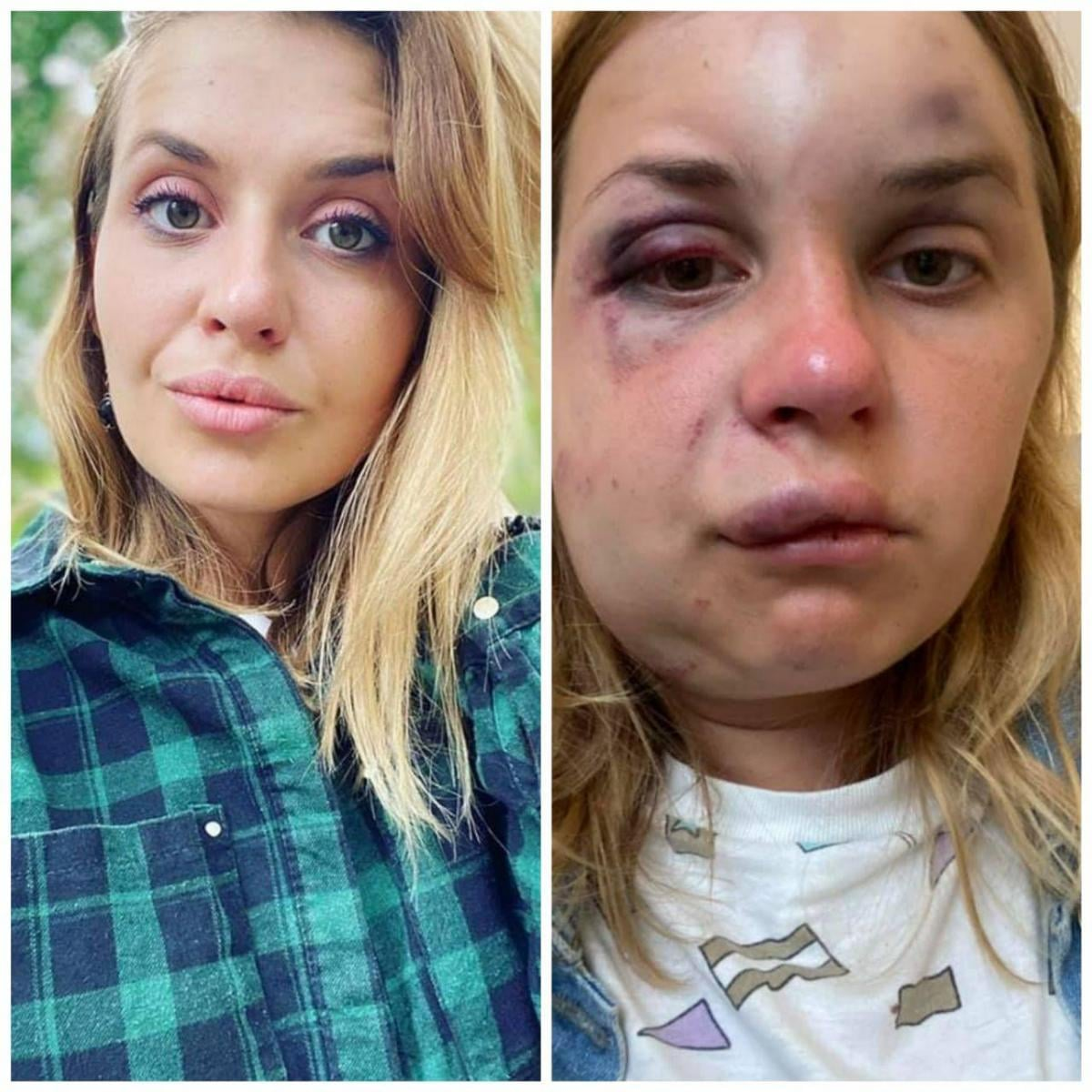 Анастасия Луговая до и сразу после нападения в поезде
