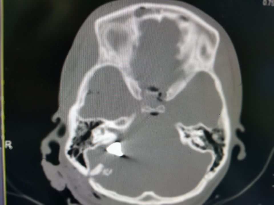 рентгеновский снимок черепа раненой в голову девушки